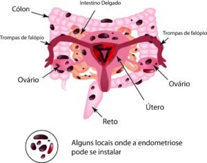 endometriose-instituto-villamil-2
