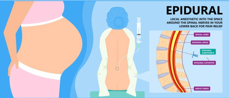 Como é a anestesia no parto normal? As anestesias e analgesias regionais consistem em estratégias usadas para bloquear a dor nas porções inferiores do corpo, abaixo da cintura. 