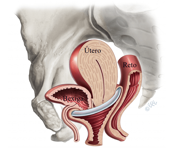 prolapso-orgaos-pelvicos-instituto-villamil-6