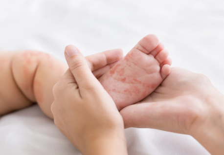 institutovillamil sarampo na criança