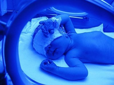 icterícia neonatal