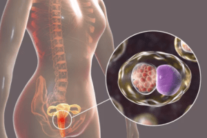 cervicite por clamídia