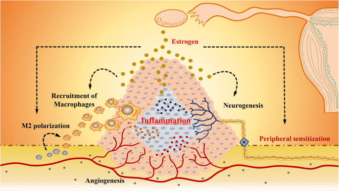 Inflamação na endometriose
