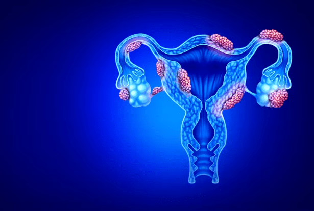 qual a ligação entre endometriose e risco de aborto