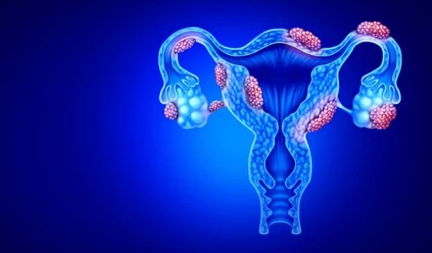 qual a ligação entre endometriose e risco de aborto